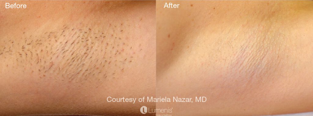 A before and after photograph of laser hair removal results using the Splendor X device by Lumenis.