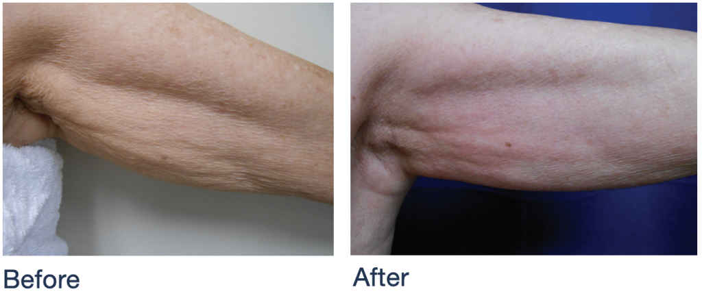 A before and after photo showing treatment results of the NuEra skin tightening device.