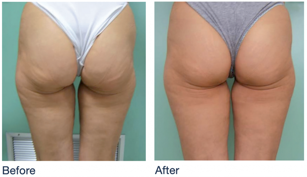 A before and after photo showing treatment results of the NuEra skin tightening device.