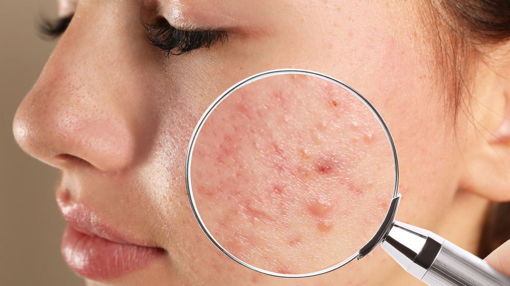 Teenage girl with acne problem visiting dermatologist, closeup with skin under magnifying glass
