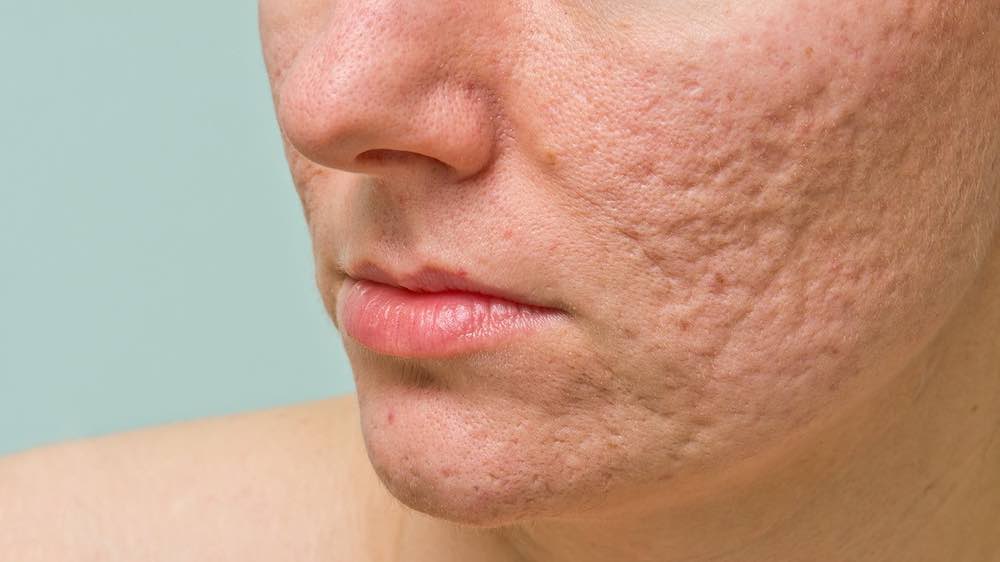 A girl is pictured with deep acne scars.