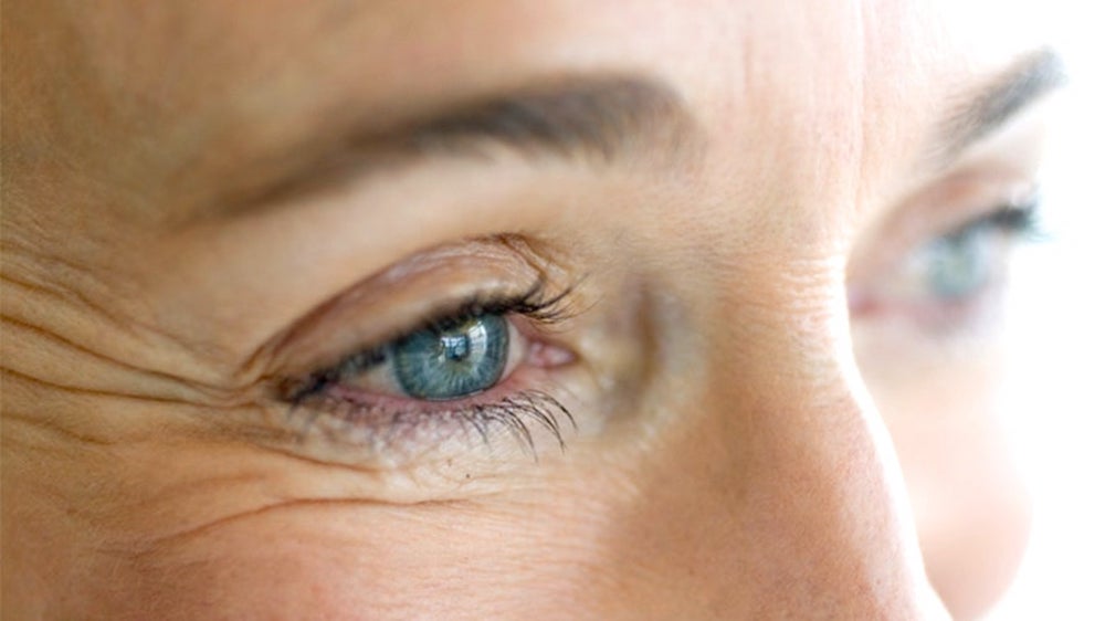 A photo of a middle-aged woman with crows feet wrinkles around her eyes before treatement.