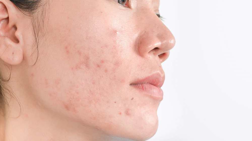 A photo of a woman with dark spots on her cheeks.