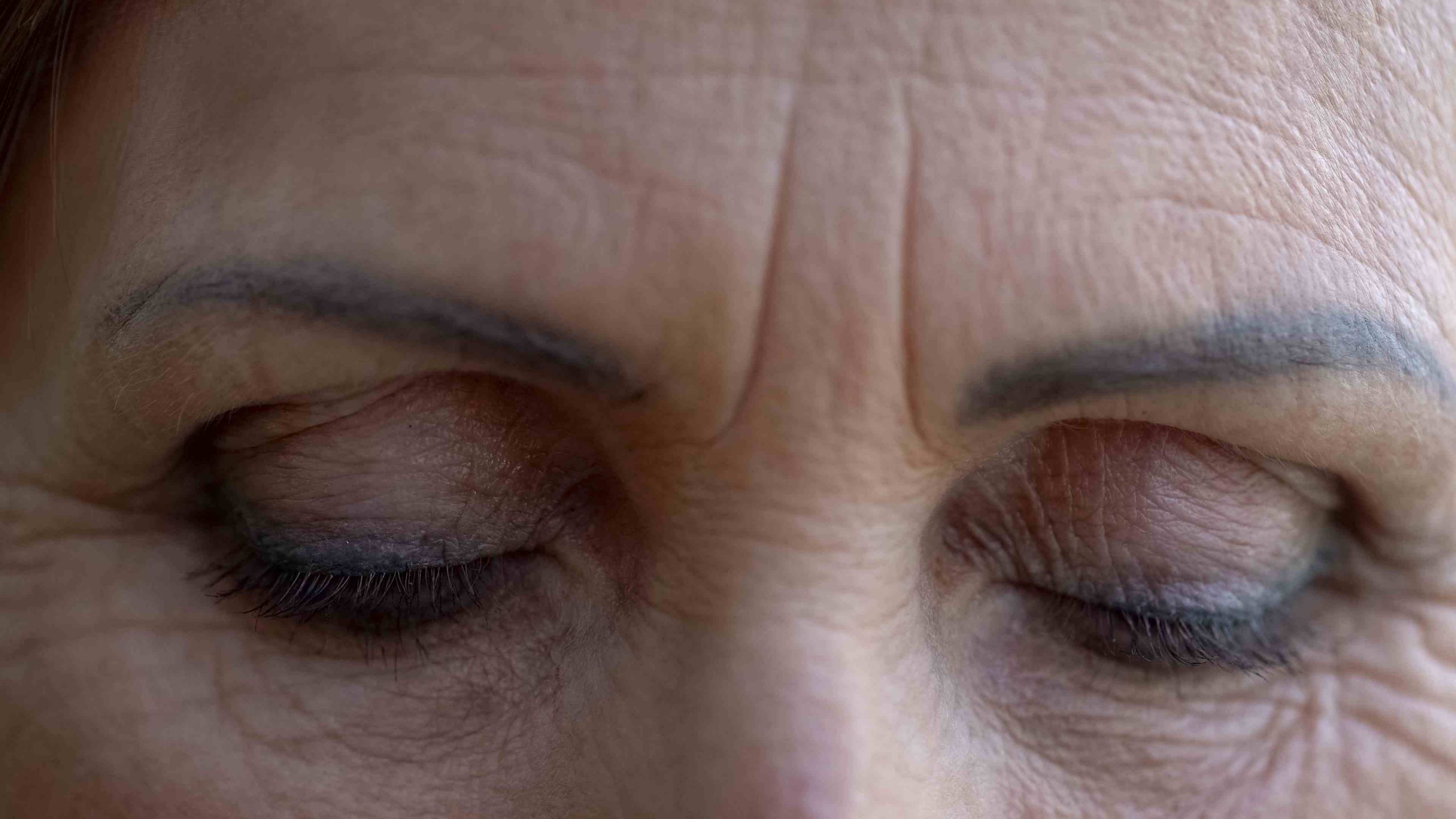 A photo of a middle-aged woman with deep wrinkles around the eyes and forehead before skin treatments.
