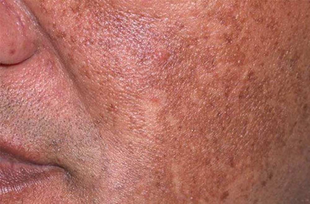 A photo of a man's cheek with hyperpigmentation before treatment.