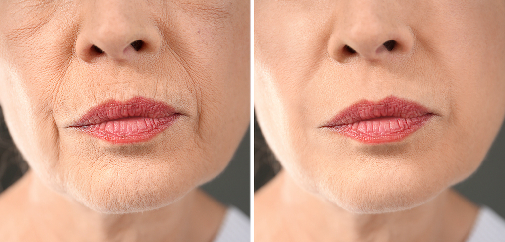 A before and after photo of fine lines and wrinkle treatments around a woman's cheeks and lips.