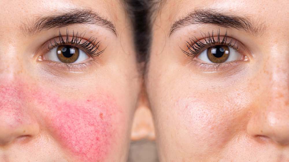 A before and after photo of a patient with rosacea.