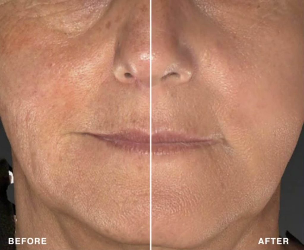 A before and after photo of a female who received SmoothGlo treatments.