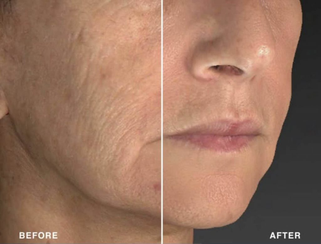 A before and after photo of a female who received SmoothGlo treatments.
