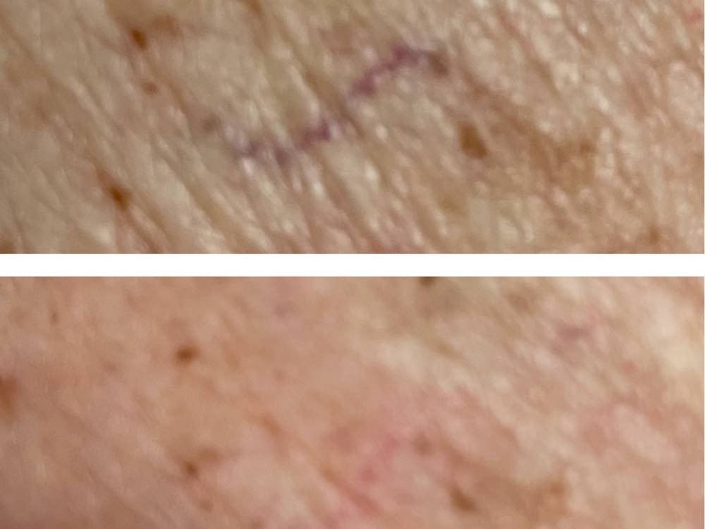 A before and after photo of spider vein treatment.