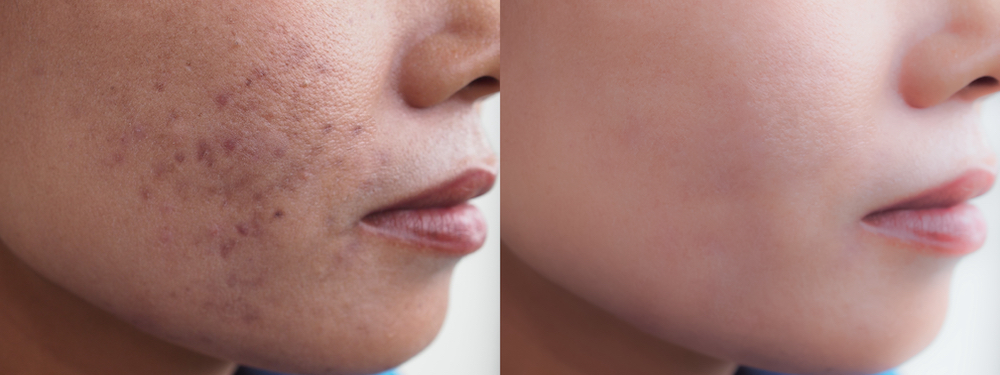A before and after photo of a woman's textured facial skin.