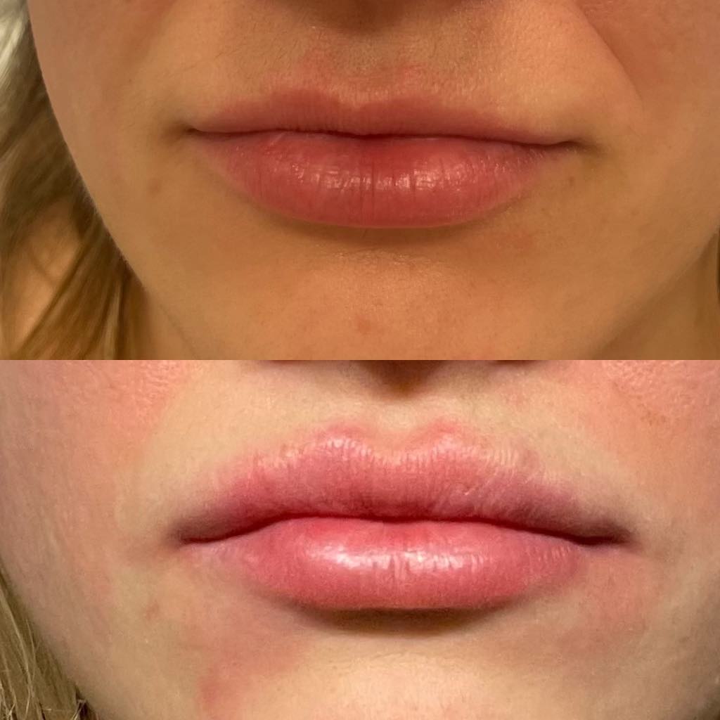 A before and after photo of a woman with lip filler treatment.