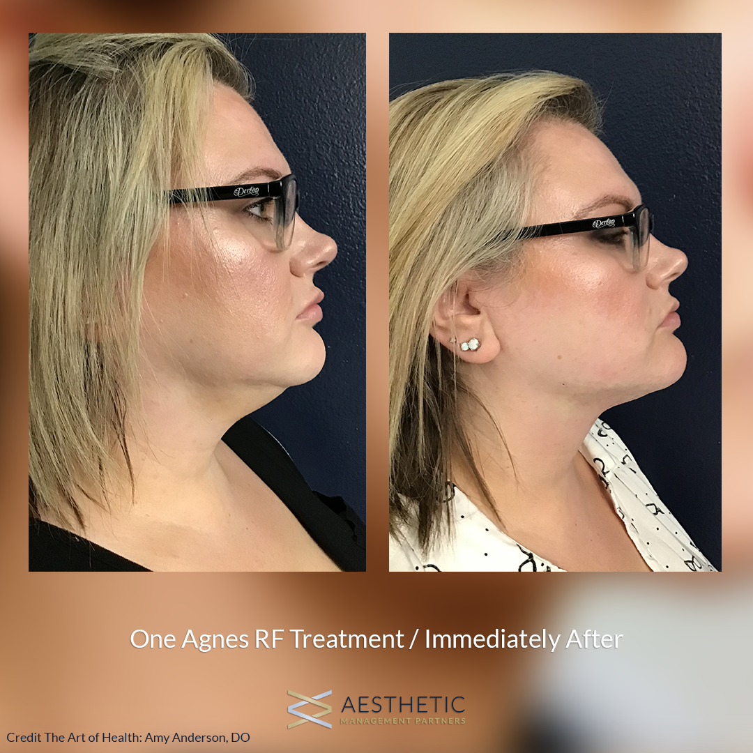 Before and after of One Agnes RF Treatment.