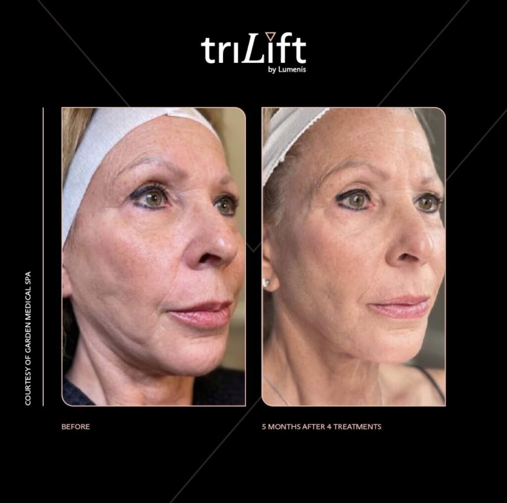 TriLift - Before and After