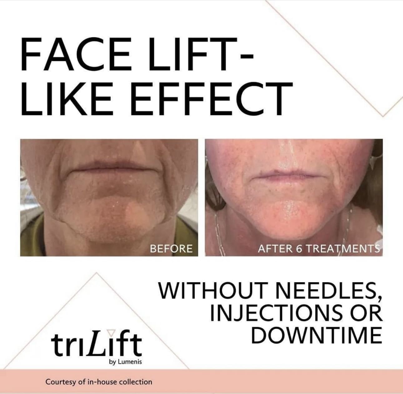 Face Lift Like Effect - TriLift
