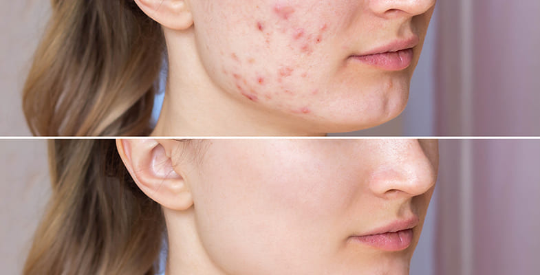 Effects Of Having Acne