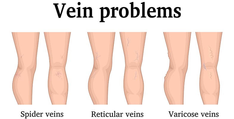 Varicose Veins and Spider Veins Differences