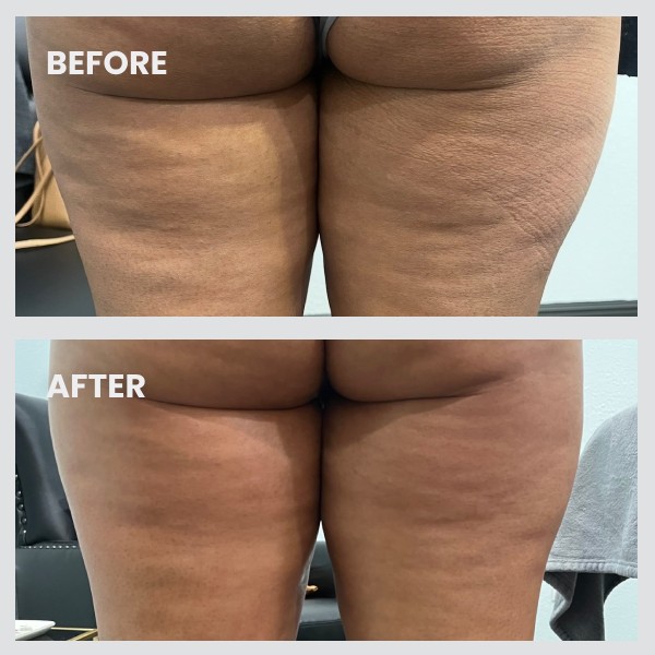 NuEra skin tightening Mansfield TX