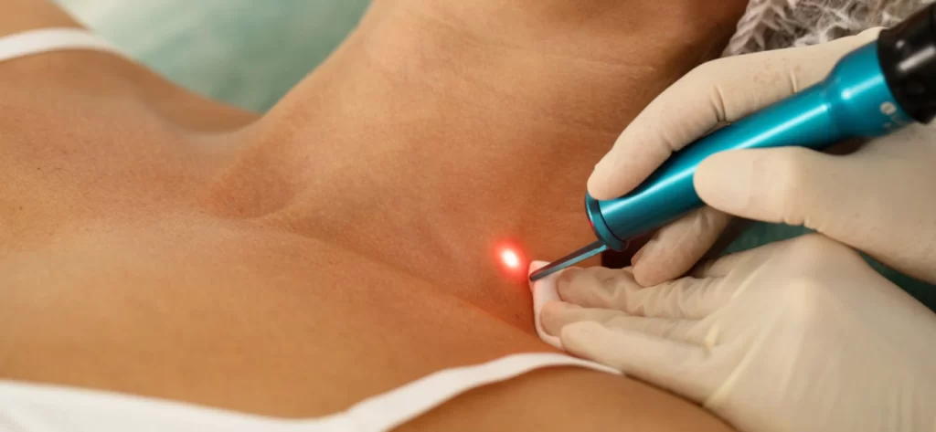 laser birthmark consultation mansfield tx