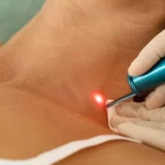 Birth Spot & Birthmark Removal with Laser in Mansfield, TX: What to Know Before Your First Treatment laser birthmark consultation mansfield tx